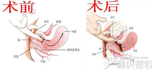 难以说出口的男性疾病阴缩
