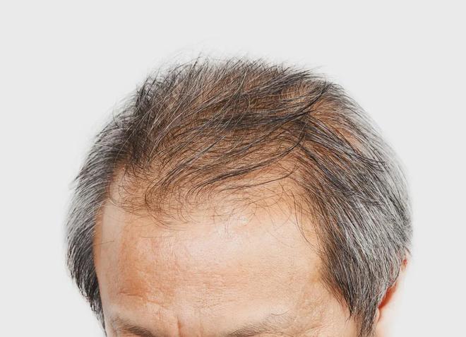 脱发+性功能减退,中年男性的两大困扰,如何一举解决。