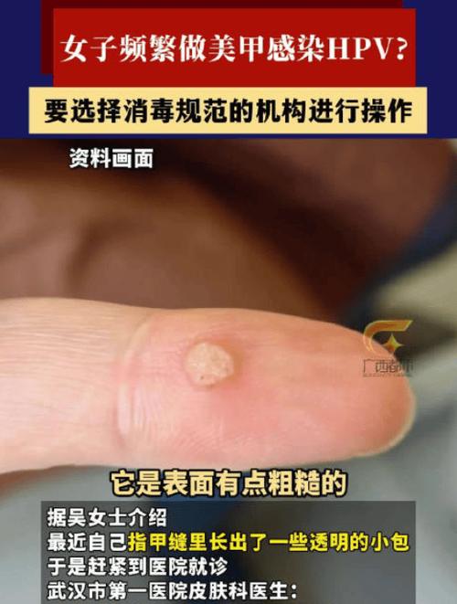 武汉一女子做美甲感染HPV磨皮造成的小破损致病毒趁虚而入