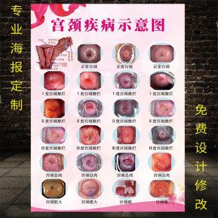 怎么治疗女性宫颈疾病。成都哪个美容看妇科好