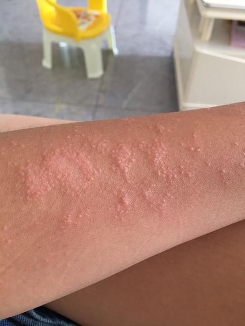 一片凸起的疙瘩很痒怎么回事