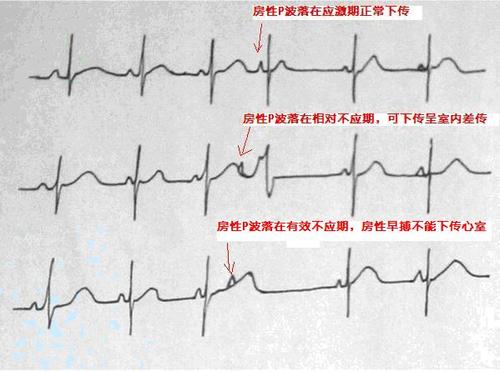 心脏早搏是怎么回事儿。