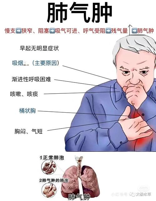 肺气肿,一种极为严重的呼吸性疾病,胸闷气短是其主要的症状
