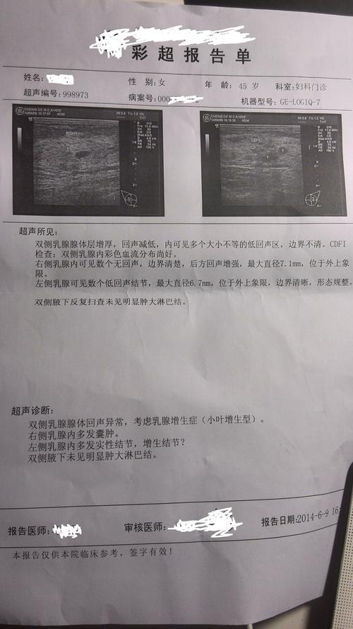 乳腺增生结节是怎么样