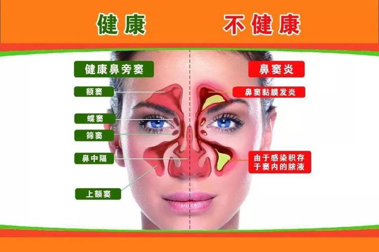鼻窦炎头痛难忍。揭秘四种类型的鼻窦炎位置和特点