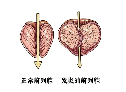 男人海洋光子治疗仪常见的前列腺疾病有哪些。都有哪些症状。