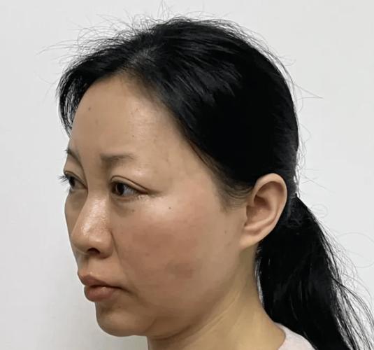 线雕知多少。线雕几天能恢复好，线雕面部提升要多久恢复自然。