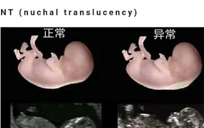 胎儿智力低下可以检查出来吗。