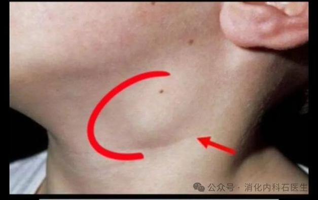 淋巴结肿大是癌症信号。医生这3个部位淋巴结肿大,需重点关注
