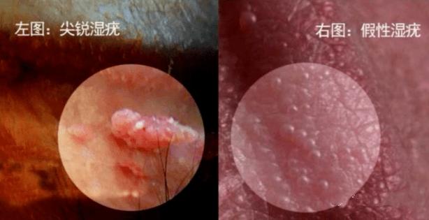 女性外阴长小疙瘩是怎么回事。