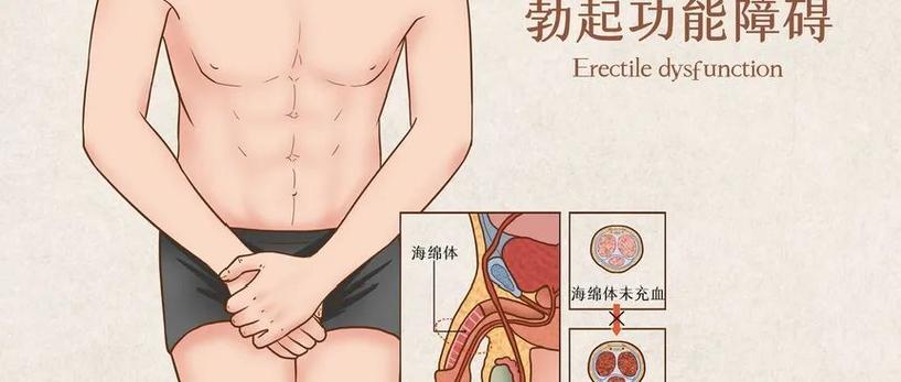 男性勃起功能障碍自查攻略,你的性生活正常吗。