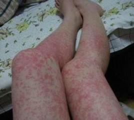 食物过敏的常见症状