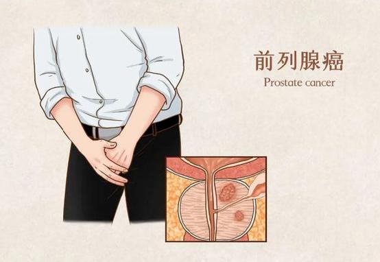 男性恶性肿瘤前五位,自查有方法!