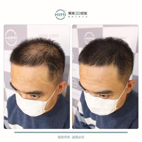 脱发、性功能减退,中年危机的正确打开方式,让你重拾雄风