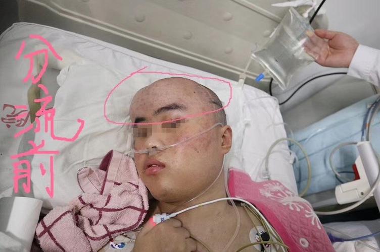 脑积水治疗后可以恢复到和正常人一样吗。