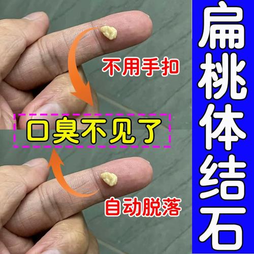 扁桃体出现结石怎么办。掌握这4个方法，可以不用去美容